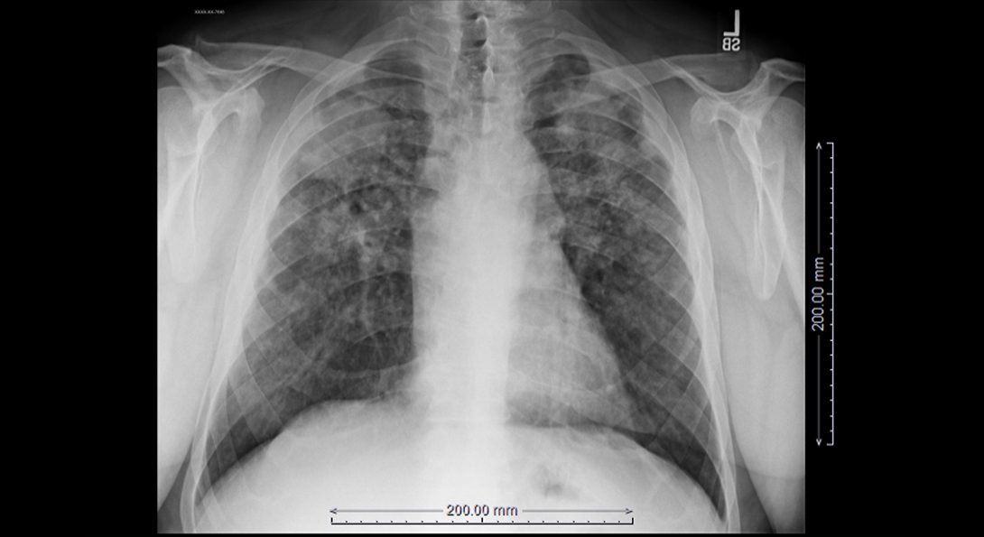 A lung x-ray from a former coal miner.