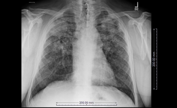 A lung x-ray of a person who worked in a coal mine, showing damage to the lungs.