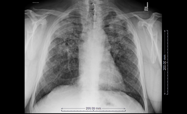 An x-ray of the lungs of a coal miner with black lung disease.